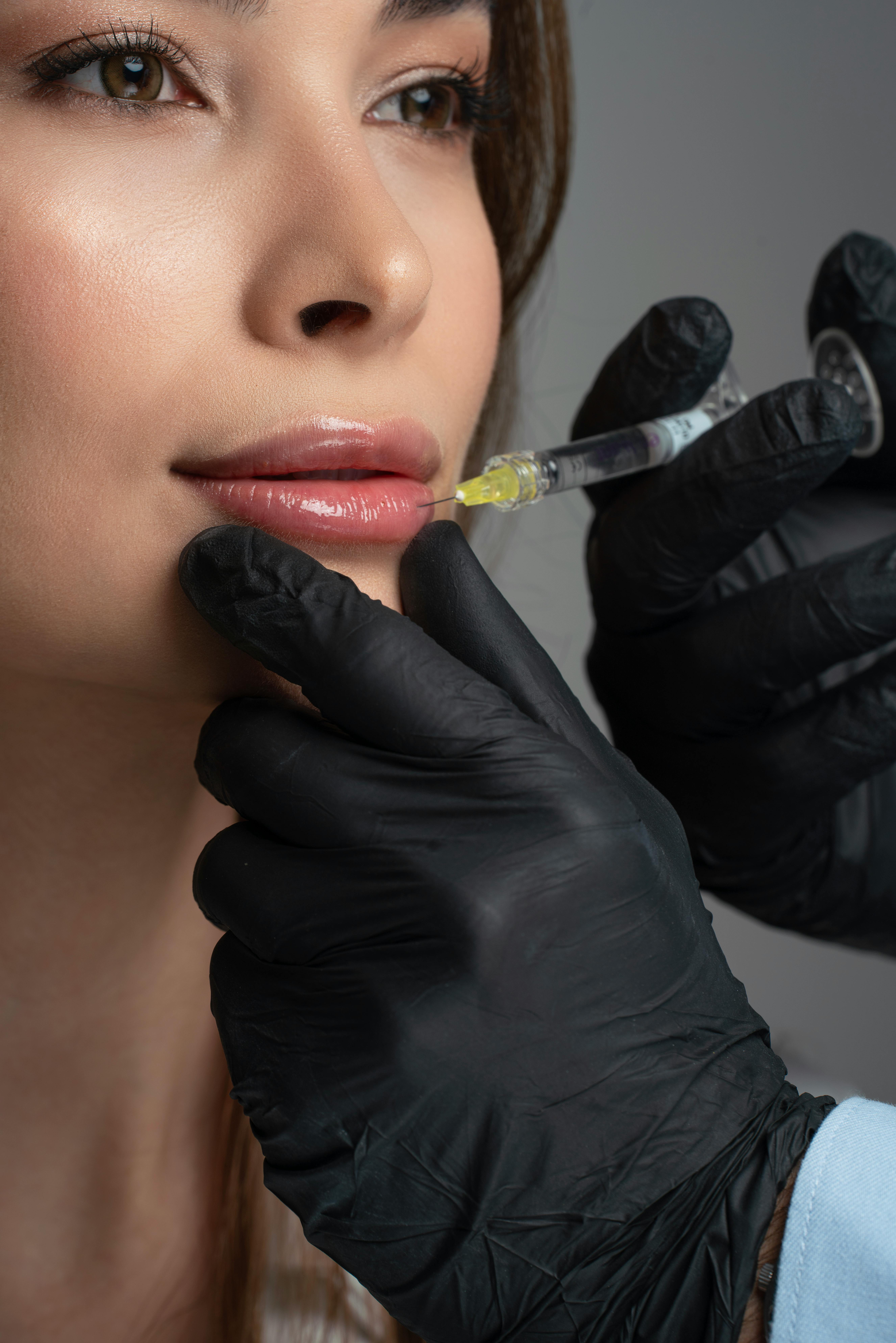 Close-up of lip filler treatment showing enhanced lip volume and smooth, defined shape